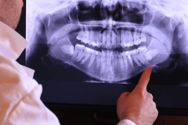 Best Knocked-Out Tooth (Avulsed Tooth) Treatment in Cortland, OH